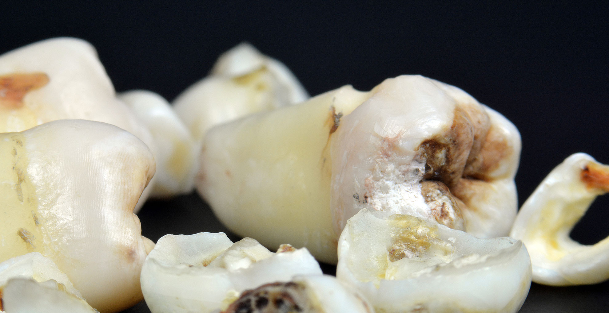 Management of Caries as a Dynamic Disease Process