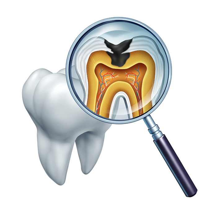 New Clinical Guidelines for Caries Management