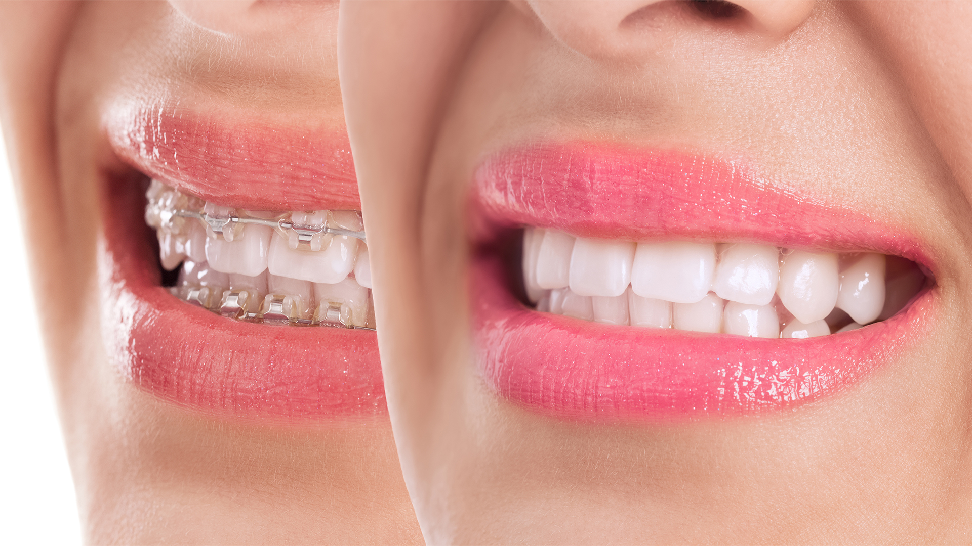 Management of White Spot Lesion Prevention for a Patient under Ortho Treatment