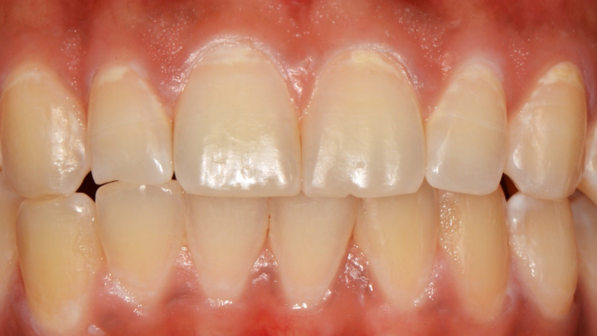 Dental Caries