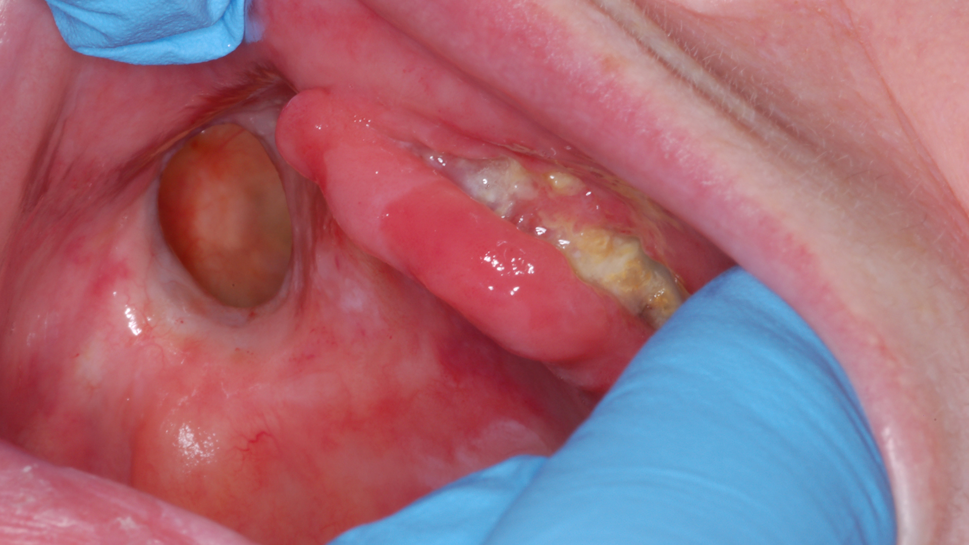 Oral Complications of Cancer Therapy Part 2: Radiation Therapy and Medication-related Osteonecrosis of the Jaw