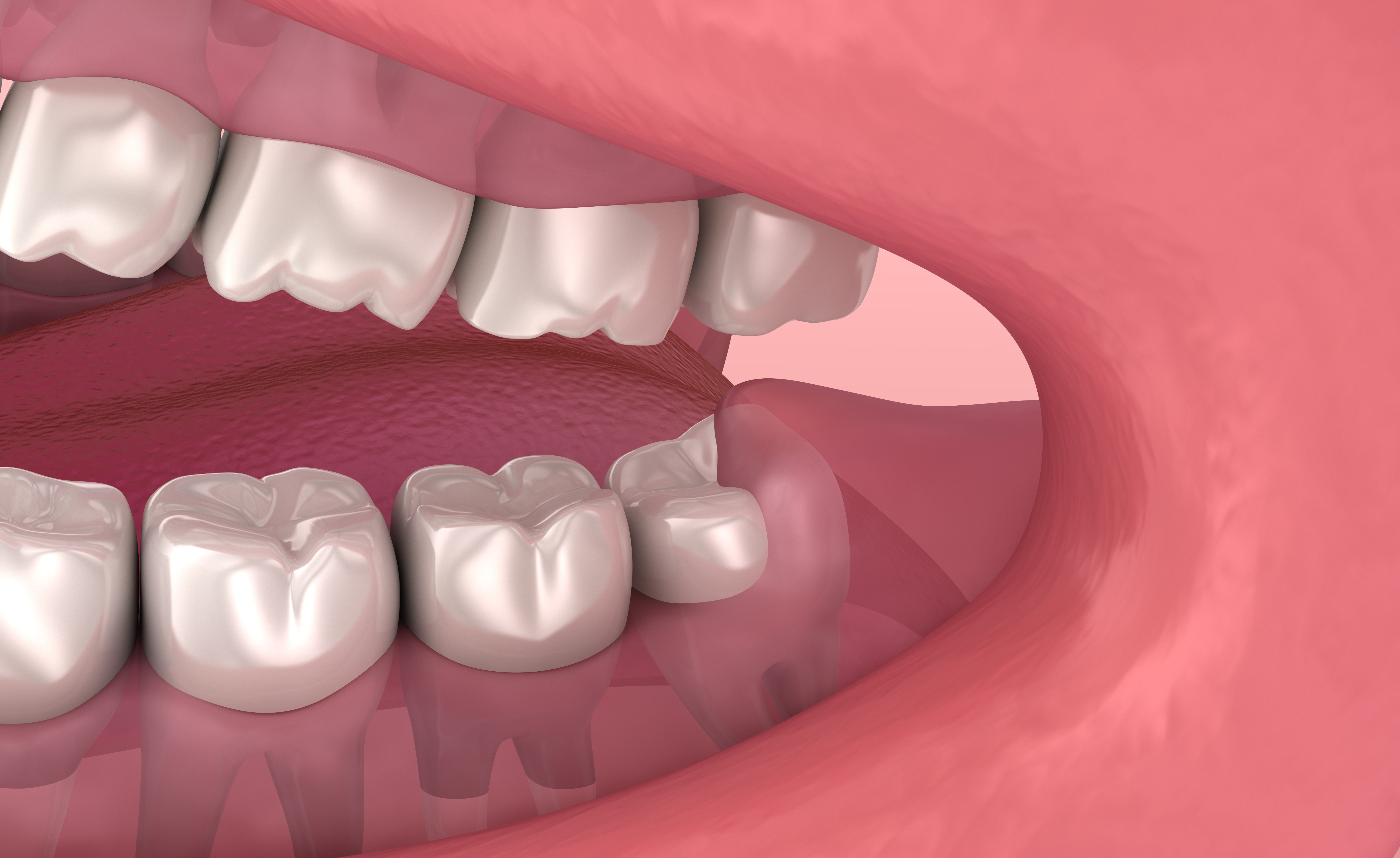 Management of Wisdom Teeth for the General Dentist