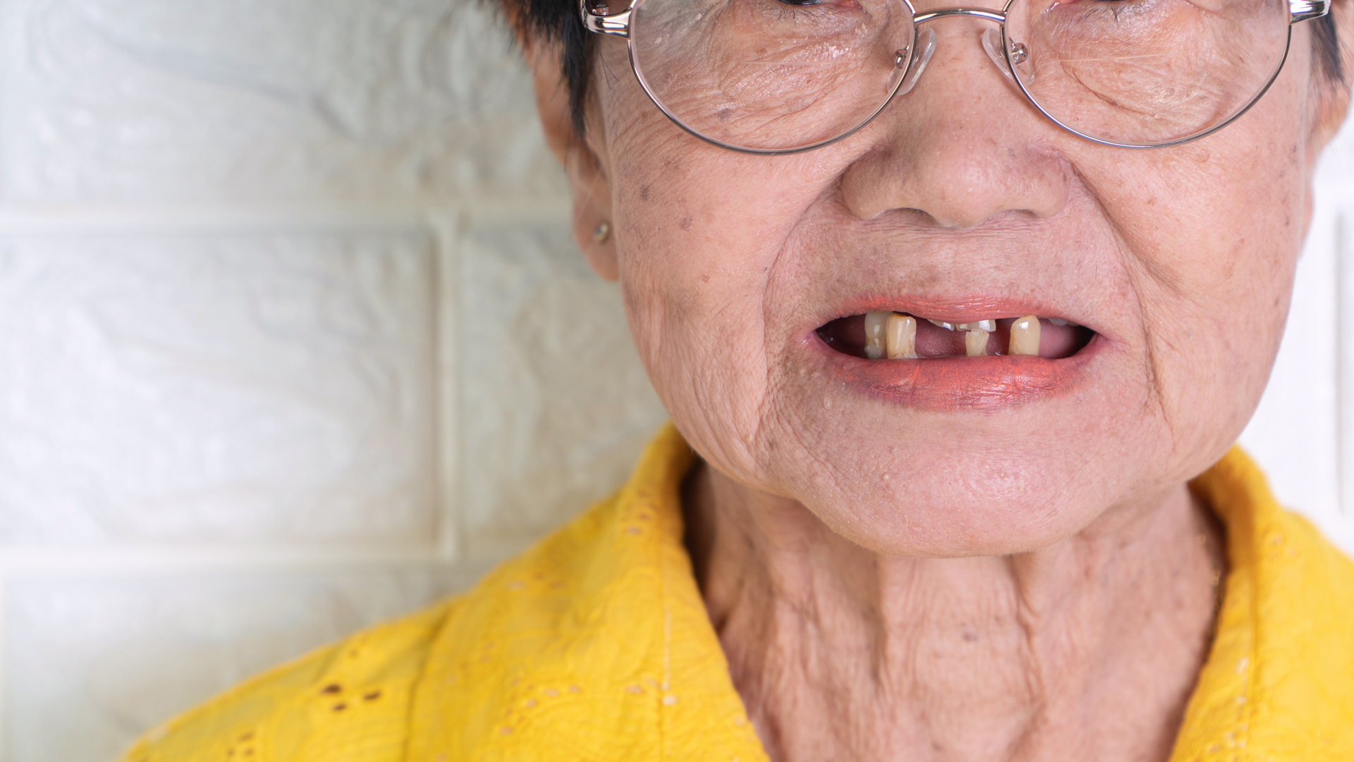 Tooth Loss, Edentulism, Aging and Geroscience