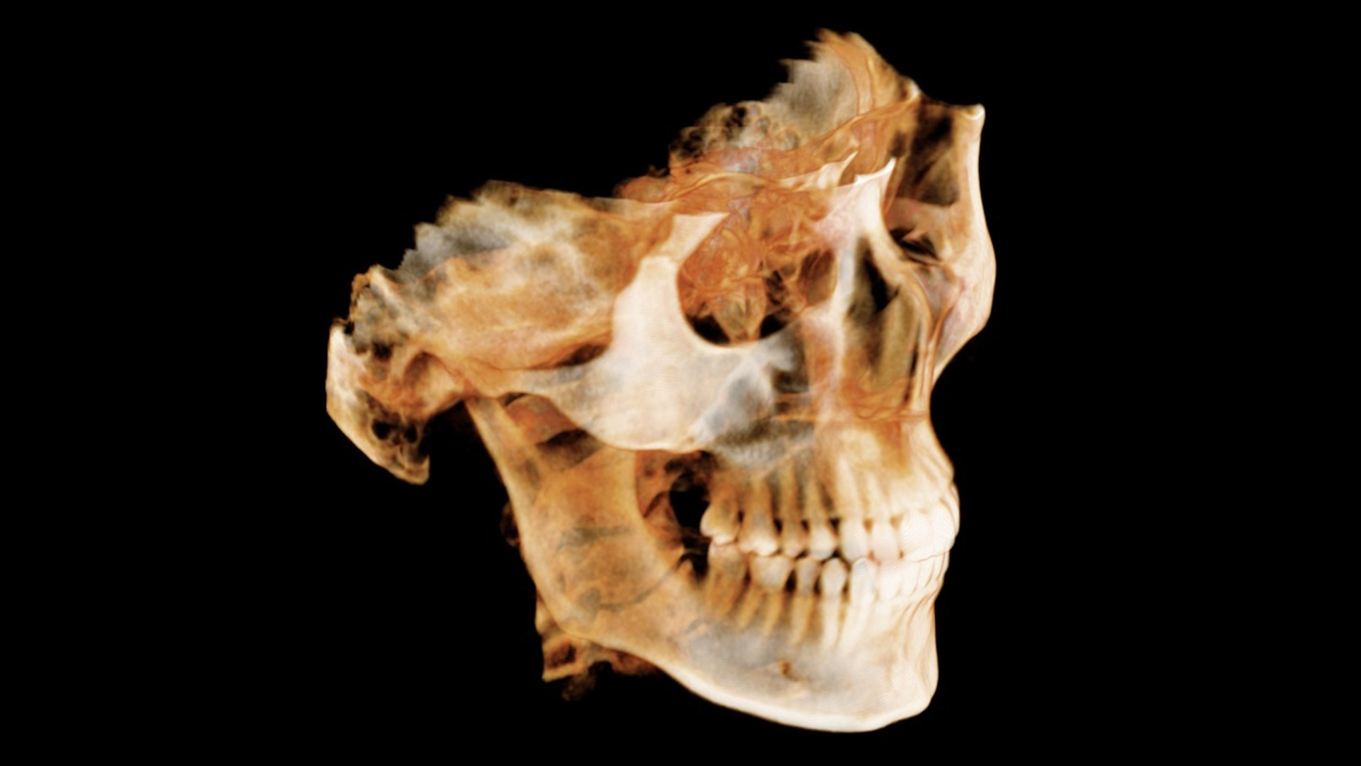 10 Radiologic diagnoses every dentist should know Part 2