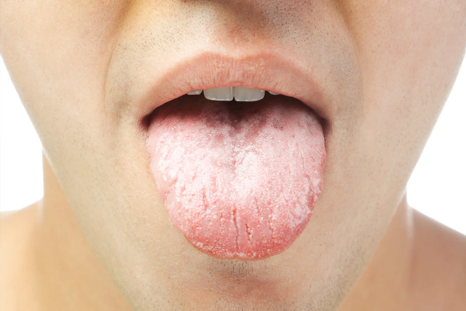 Trends and Demographics: Dry Mouth