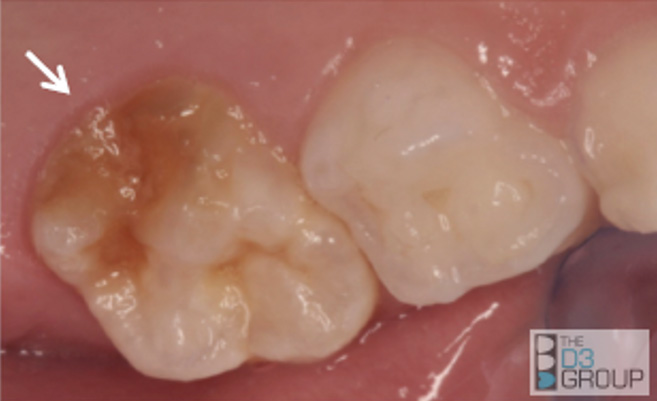 Reconsidering Molar Hypomineralization and “Chalky Teeth”