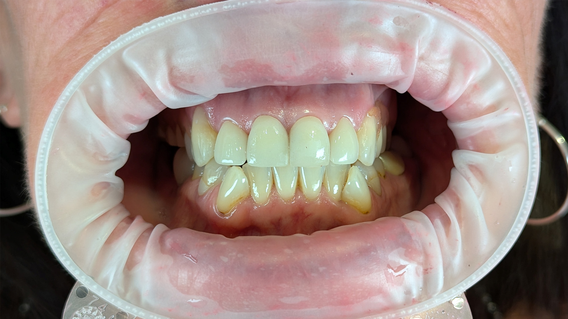 Caries Management in the Aesthetic Region and Producing an Excellent Aesthetic Outcome with Prosthodontics