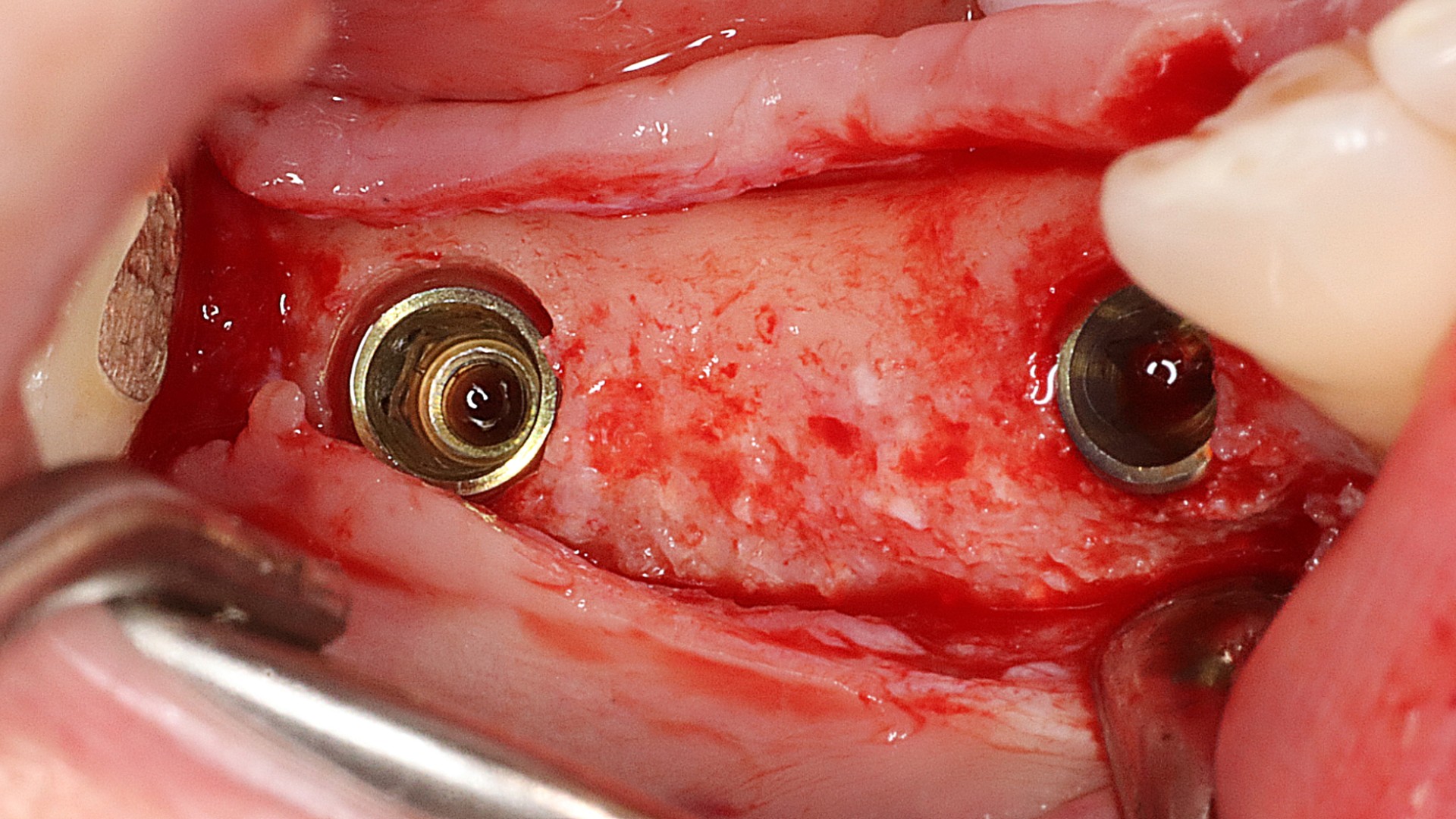 Optimized Dental Implant Osseointegration: Cellular Mechanisms, Timelines, and Patient Factors Optimized Dental Implant Osseointegration: Cellular Mechanisms, Timelines, and Patient Factors