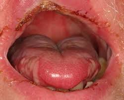 Oral Mucositis: Oral Impact, Sequelae and Management