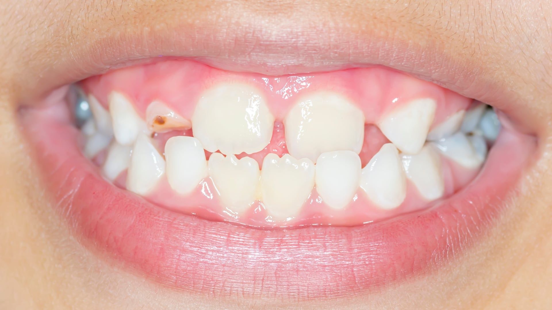 Paediatric Dentistry Evidence Uncovered: Global Consensus in Action